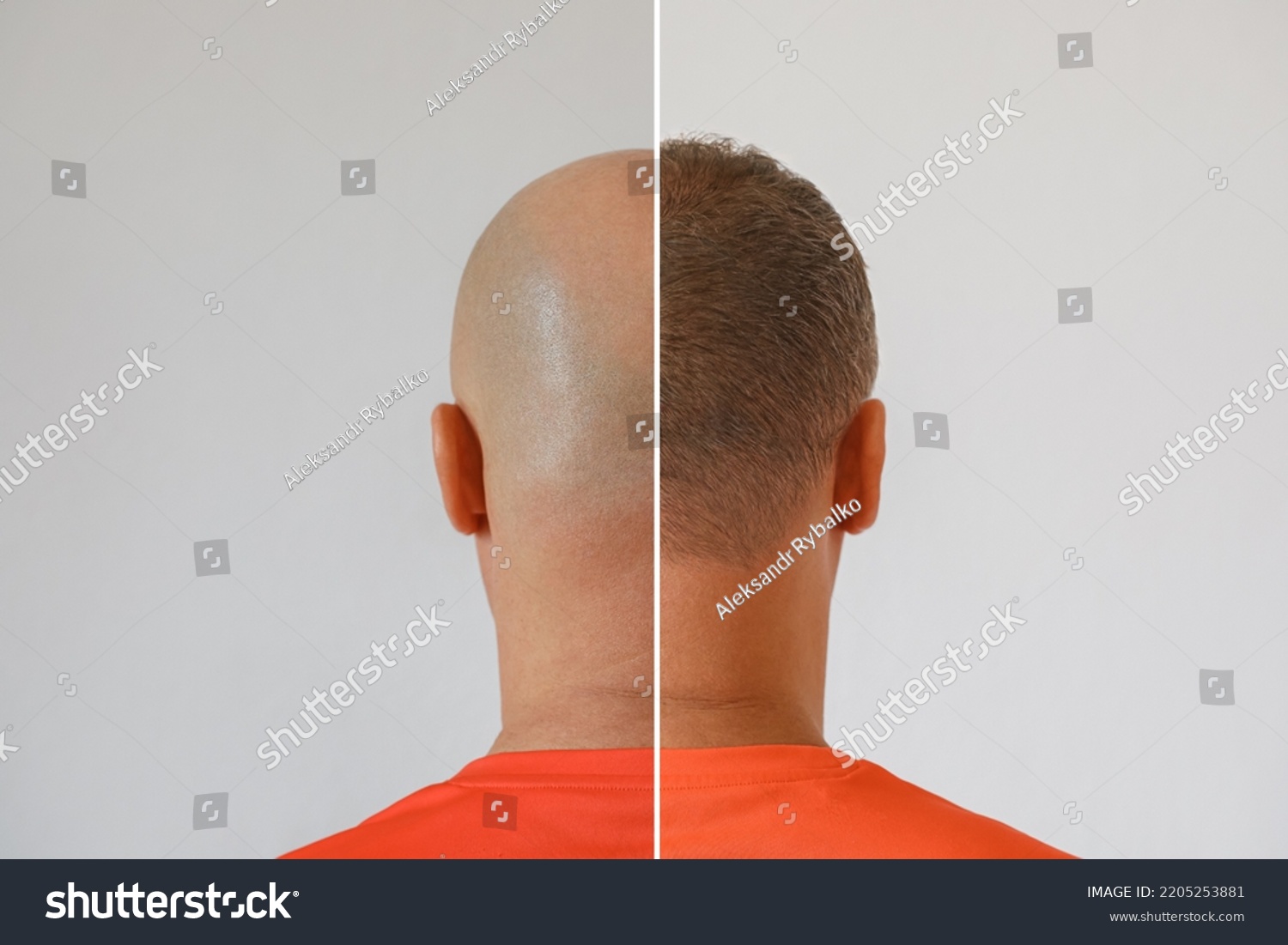 Head Balding Man Before After Hair Stock Photo 2205253881 | Shutterstock