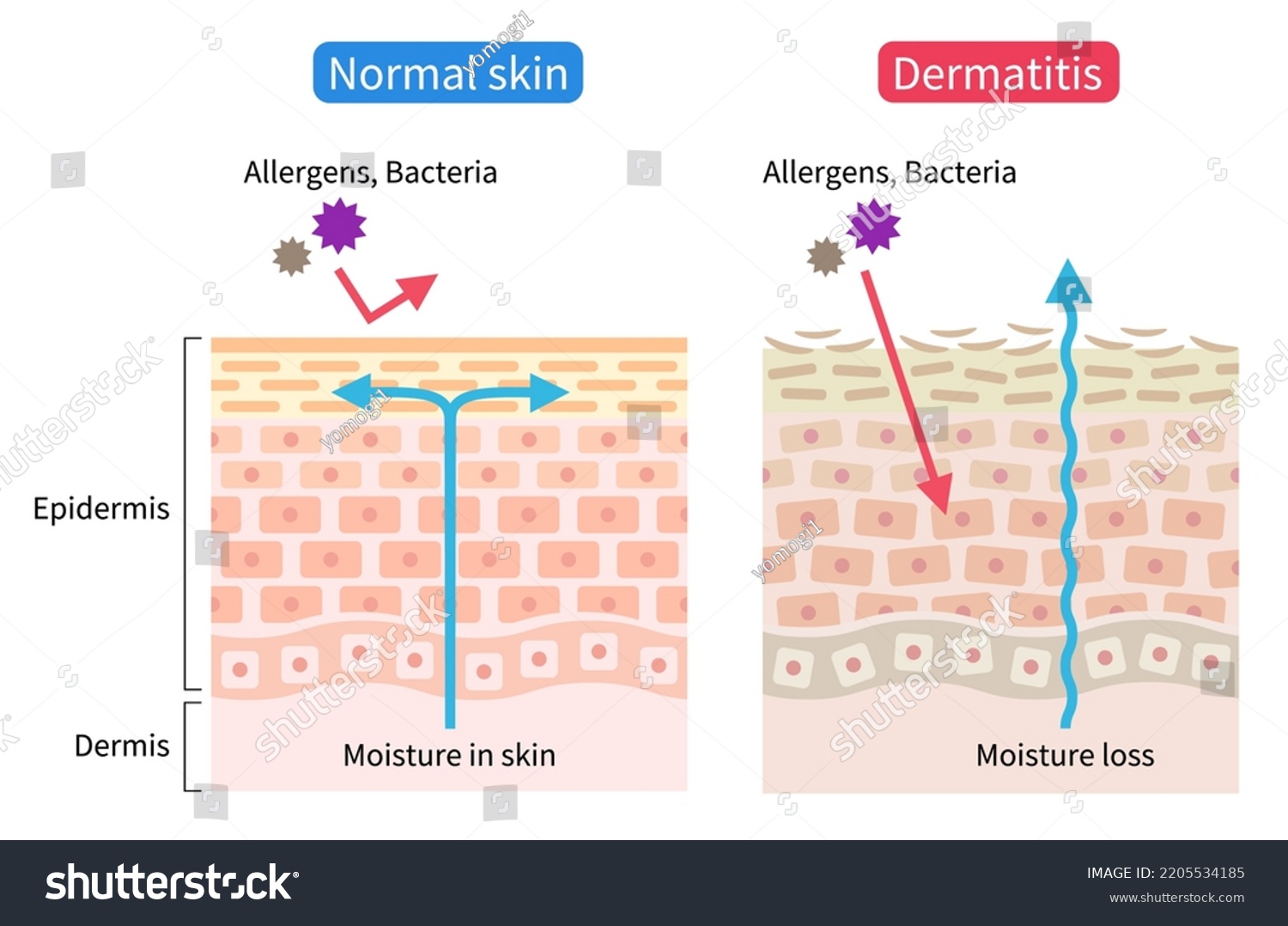 Atopic Dermatitis Eczema Dry Normal Skin Stock Vector (Royalty Free ...