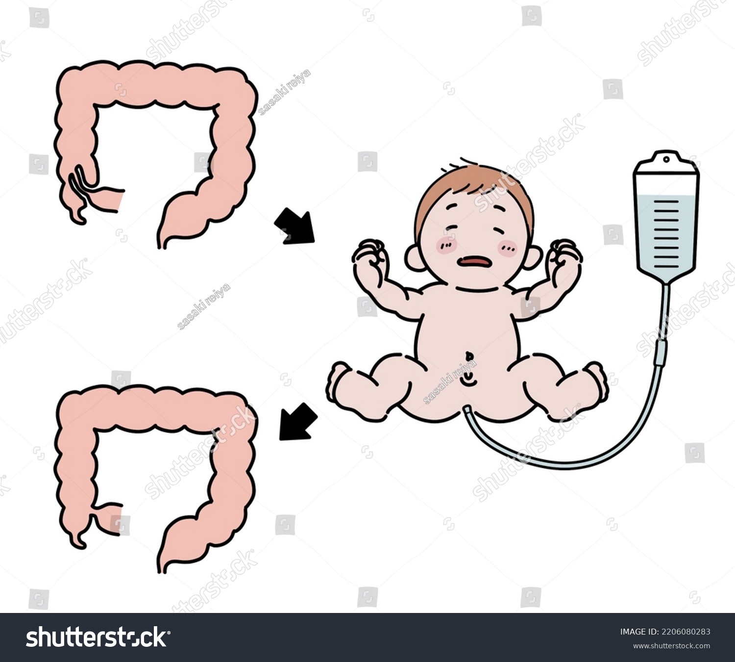 High Pressure Enema Intussusception Stock Illustration 2206080283