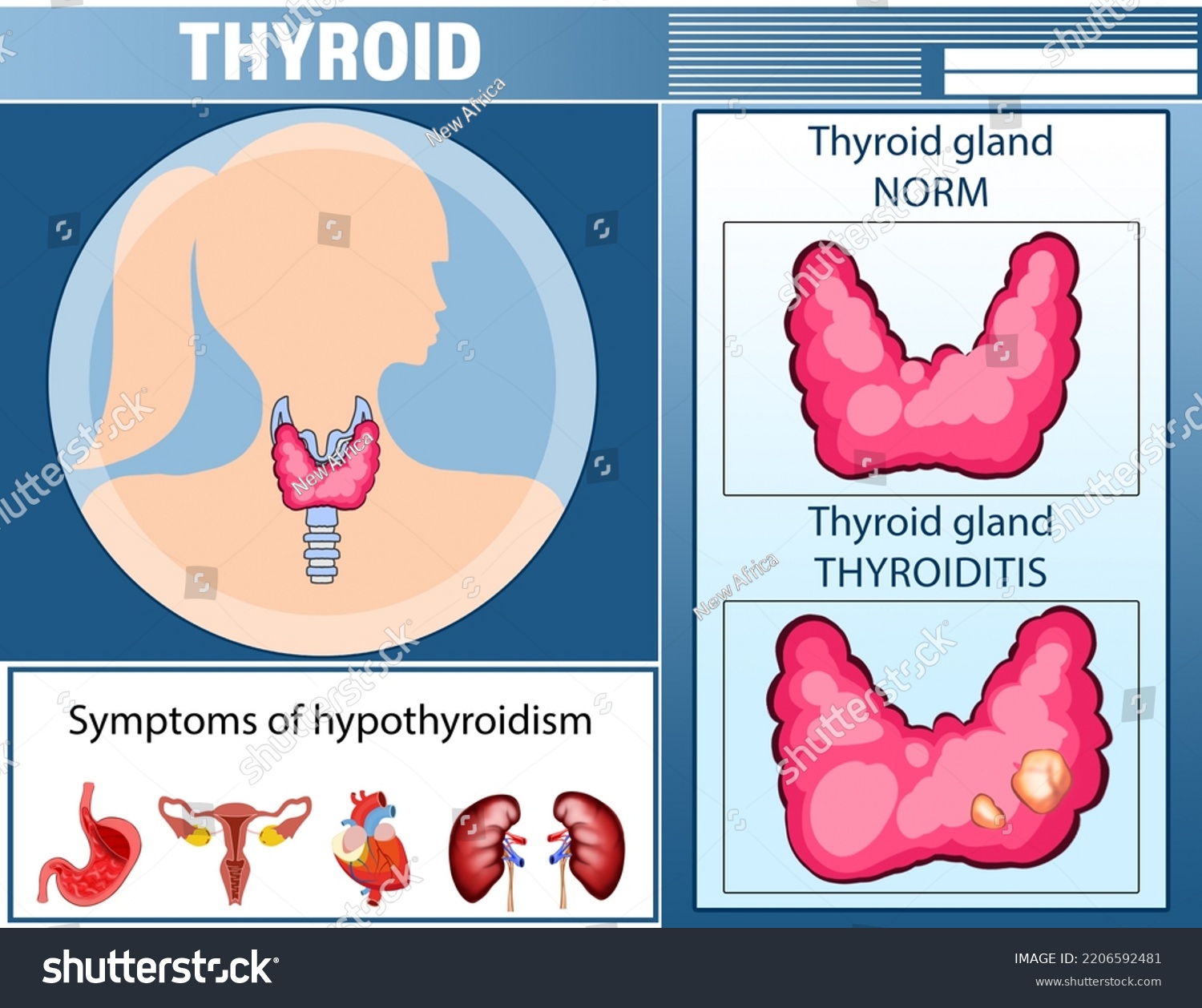 Illustration Thyroid Gland Symptoms Hypothyroidism Medical Stock