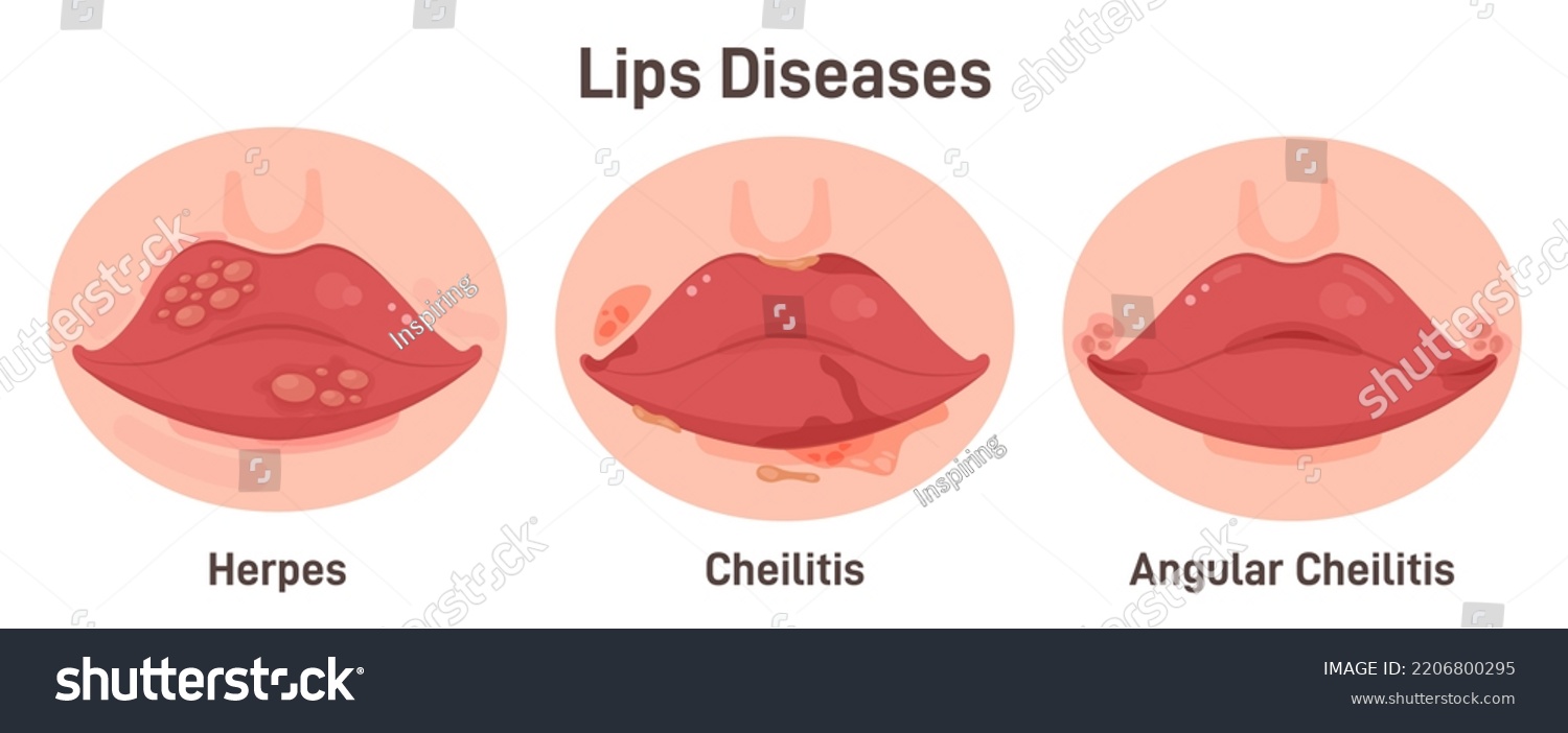 human-lips-disease-herpes-cheilitis-angular-stock-vector-royalty-free