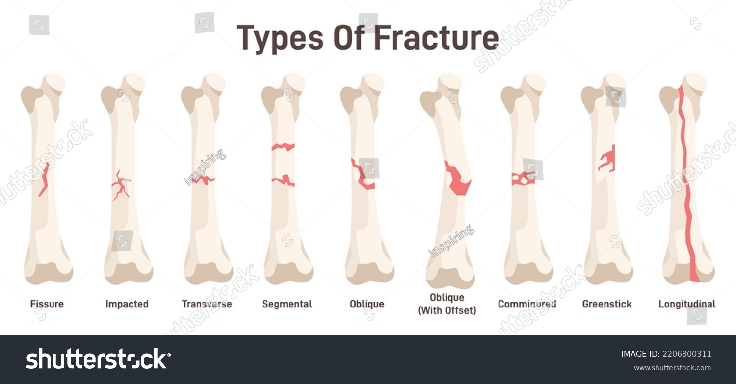 Types Bone Fractures Body Injury Partial Stock Vector (Royalty Free ...