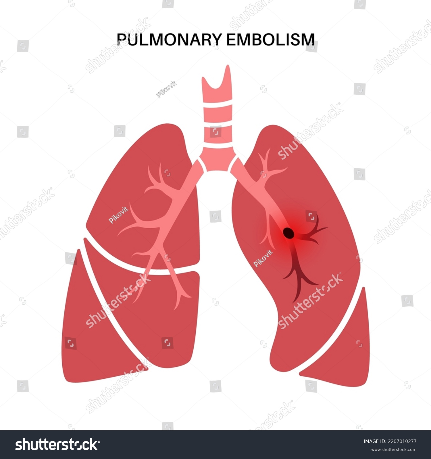 Pulmonary Embolism Disease Deep Vein Thrombosis Stock Vector Royalty Free 2207010277