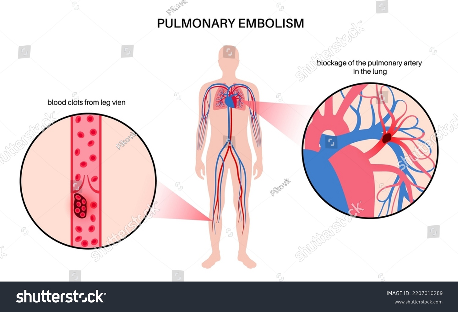 Pulmonary Embolism Disease Deep Vein Thrombosis Stock Vector Royalty Free 2207010289