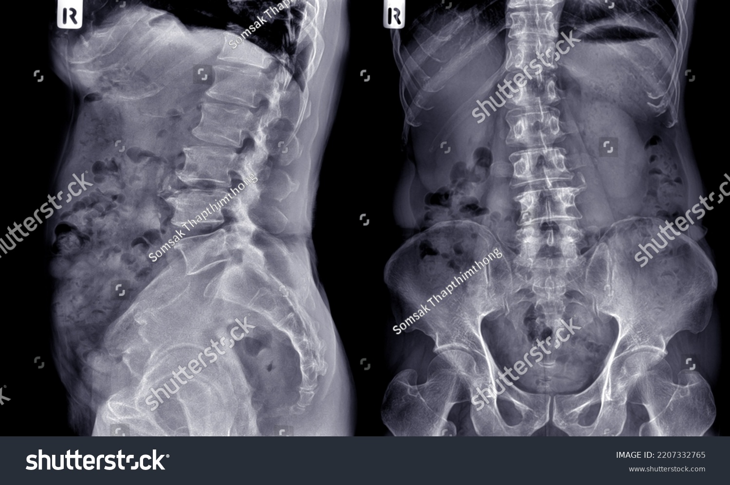 Xray Image Anterior Lateral Spine Perspective Stock Photo 2207332765 ...