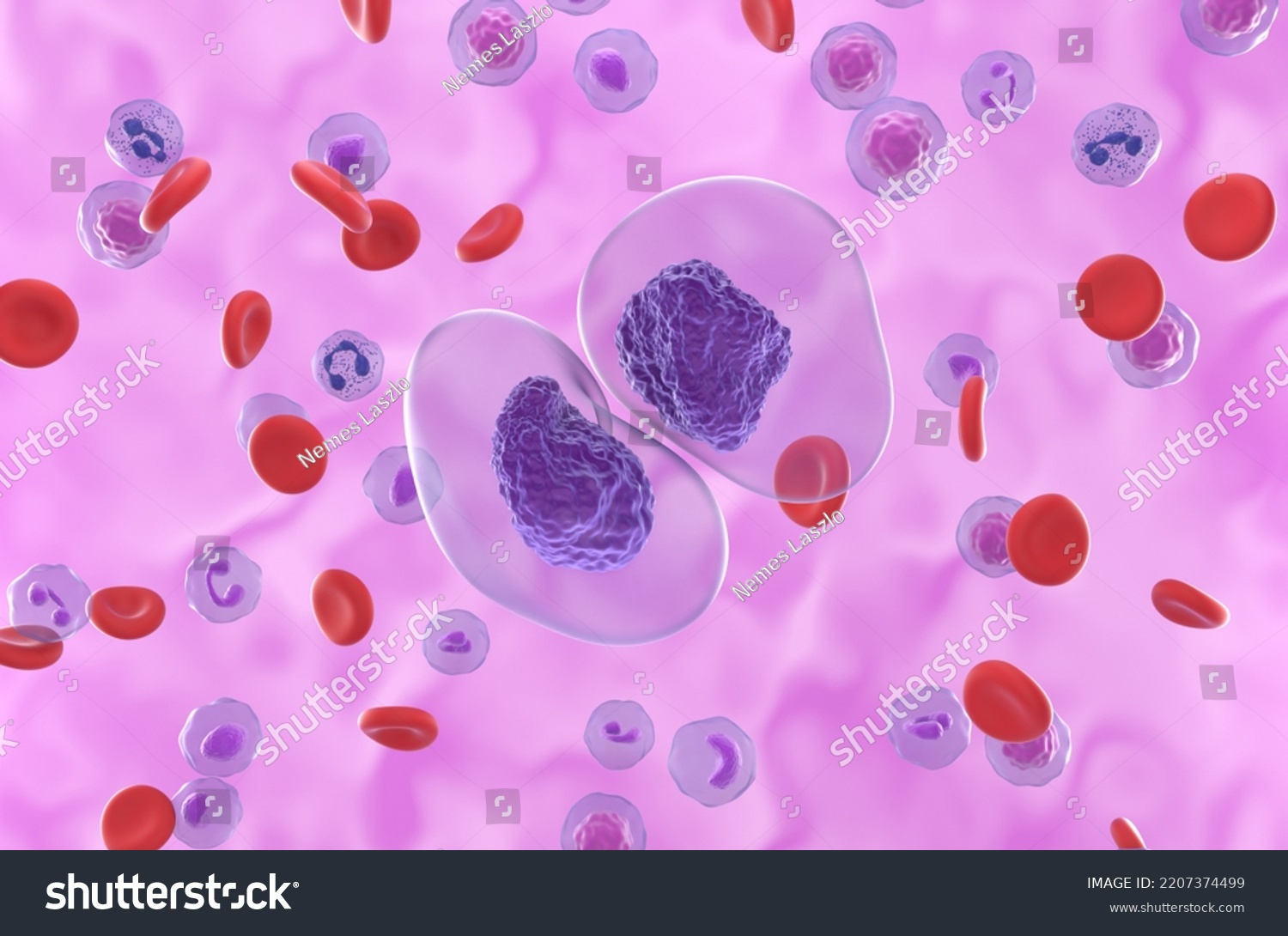 9 Prolymphocytic Leukemia Images, Stock Photos & Vectors | Shutterstock