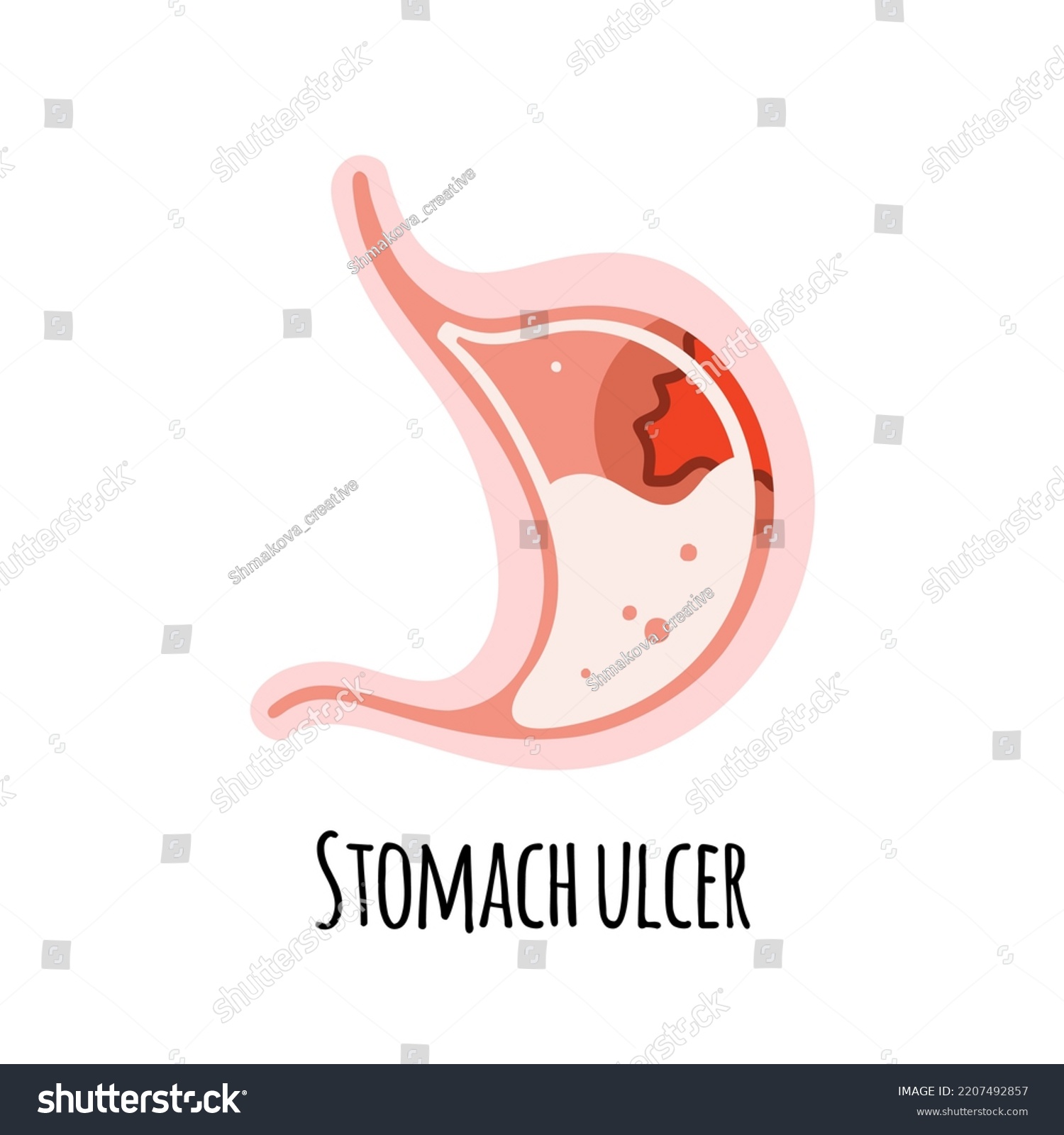 Stomach Person Ulcer Gastroenterology Vector Illustration Stock Vector ...