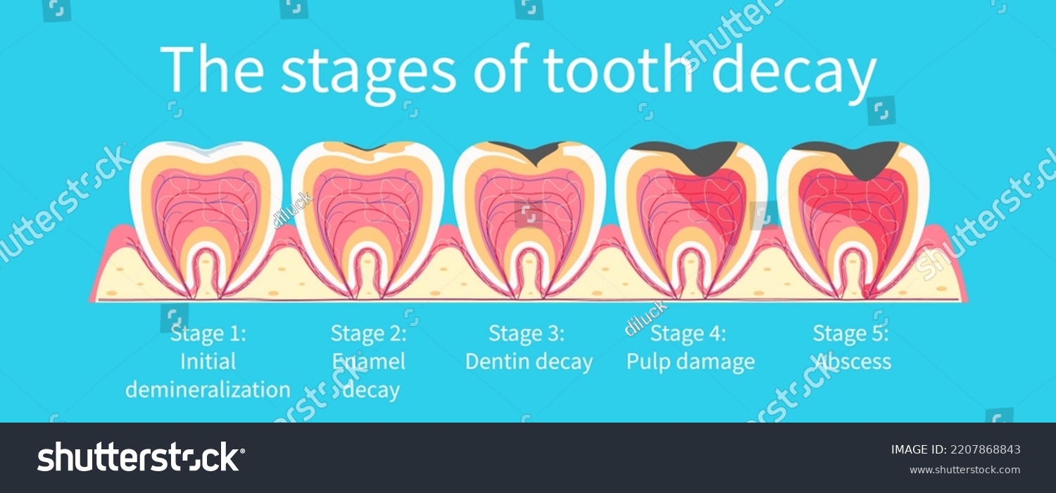 Stages Development Tooth Decay Dental Plaque Stock Vector (Royalty Free ...