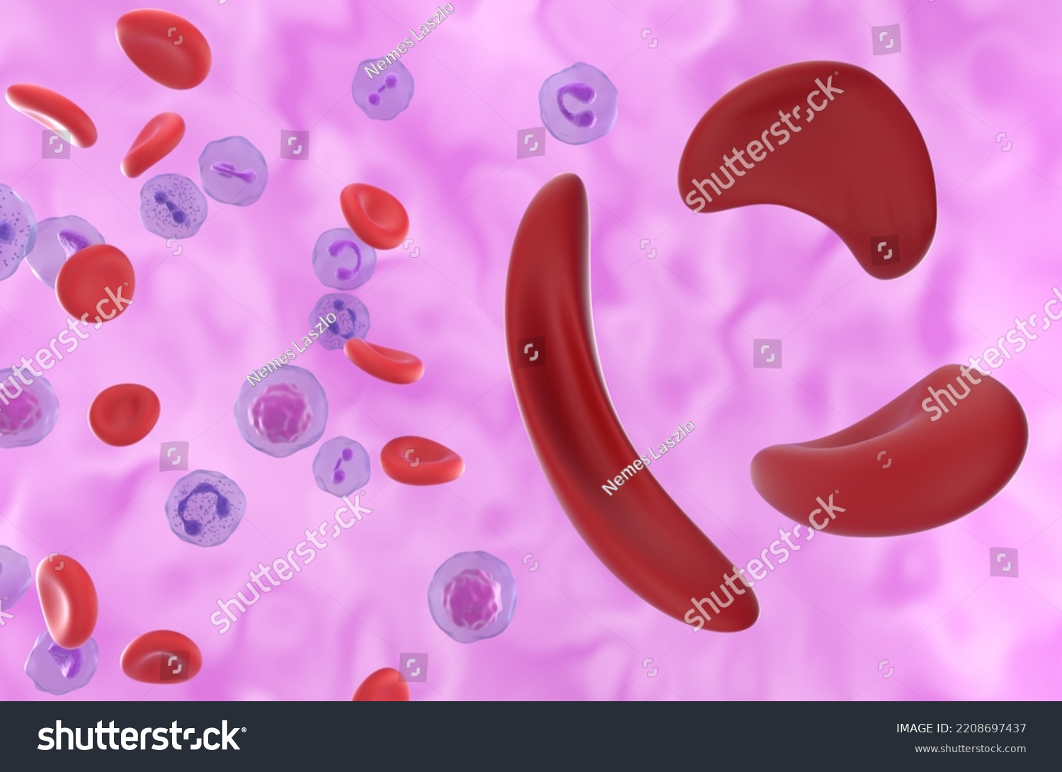 Sickle Cell Anaemia Sickle Cell Disease Stock Illustration 2208697437 ...