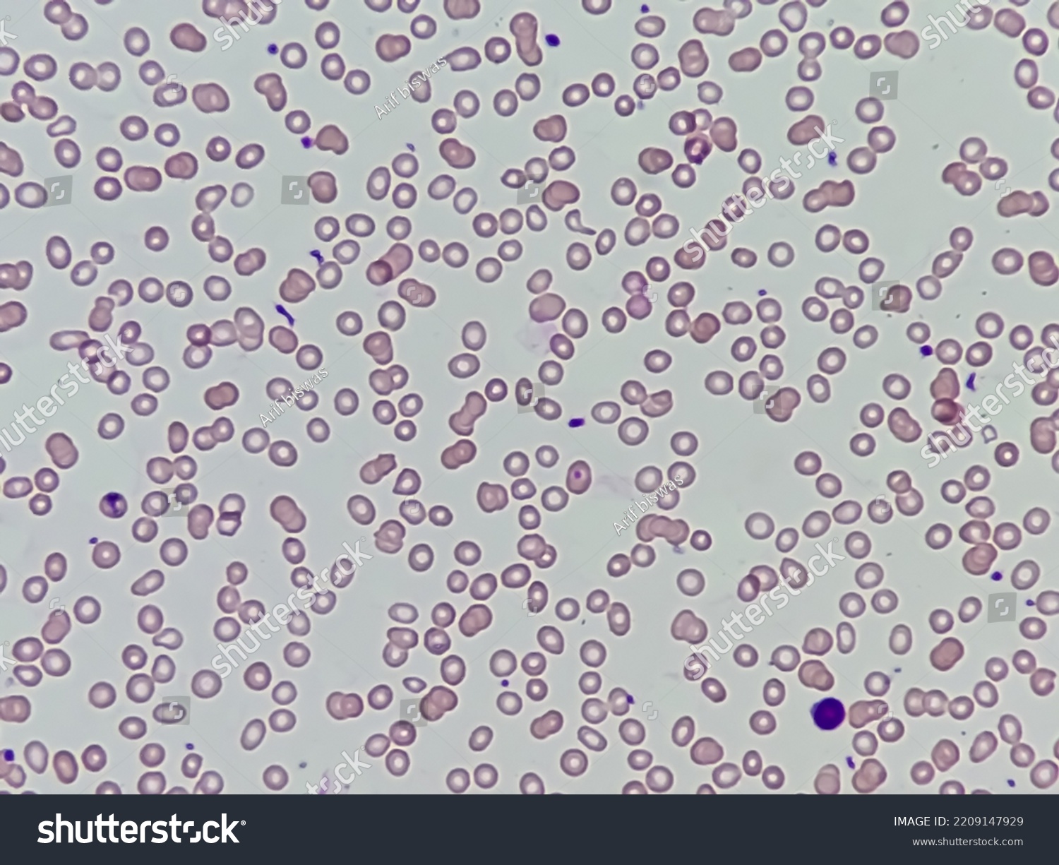 Microscopic Image Macrocytic Anaemia Thrombocytopenia Folic Stock Photo ...