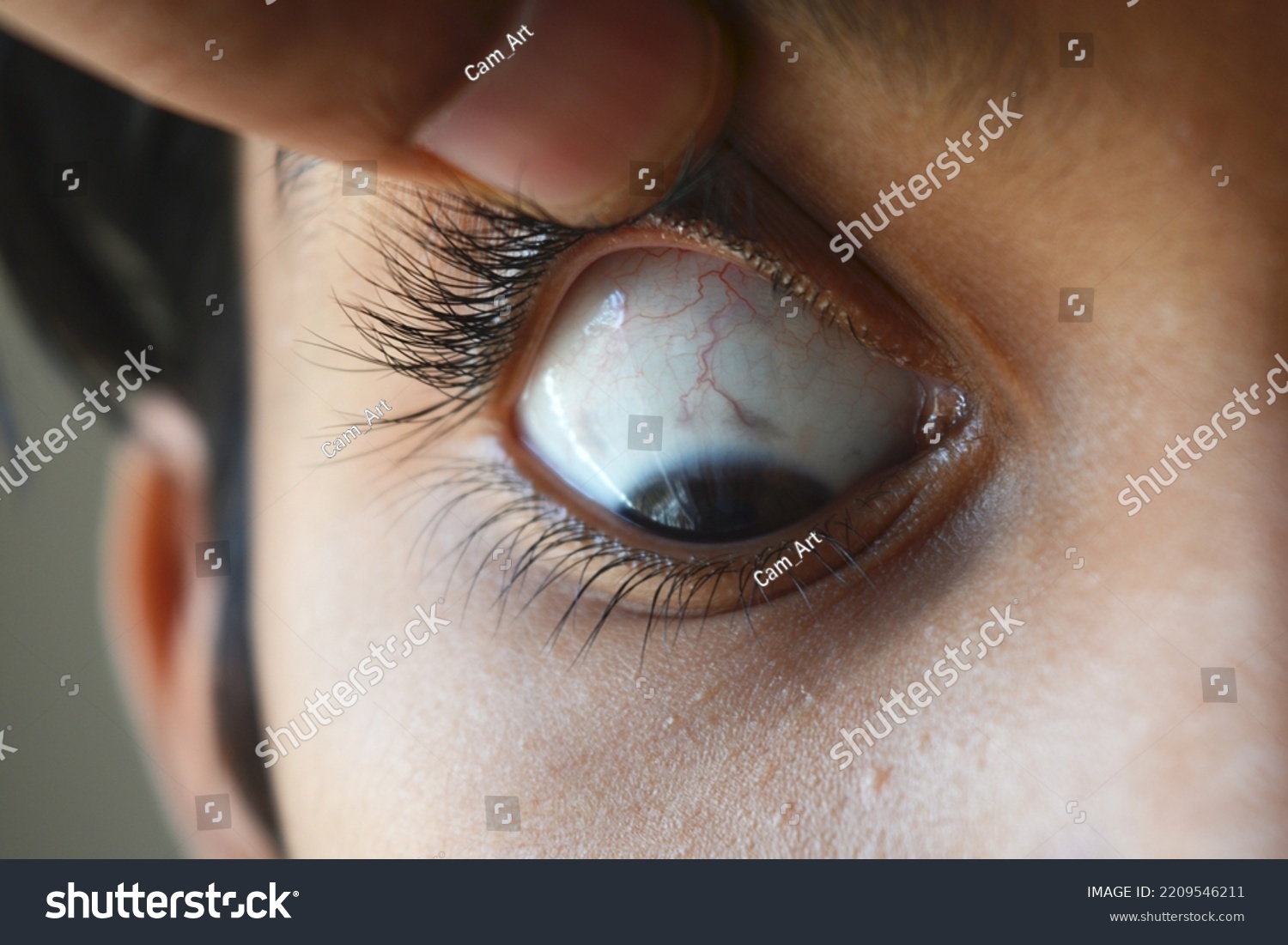 Method Demonstrating Clinical Examination Sclera Icterus Stock Photo ...