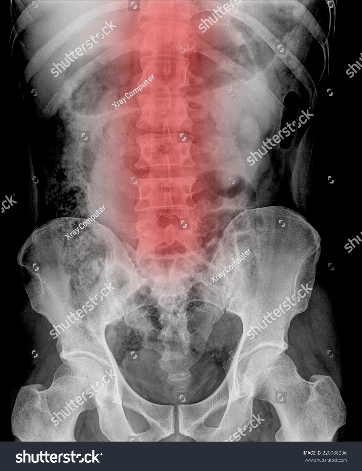 X Ray Kidney Stones Stock Photo 220988206 | Shutterstock