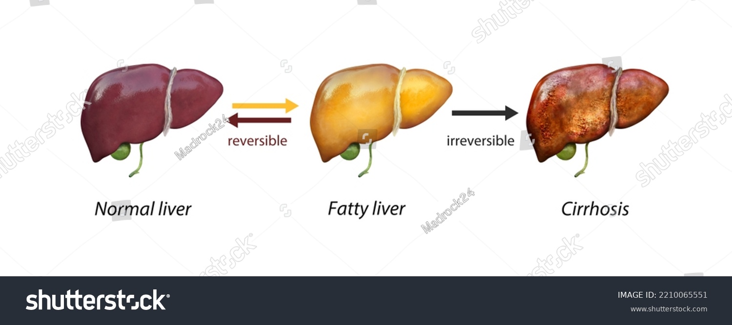 Normal Liver Versus Liver Cirrhosis Damaged Stock Illustration ...