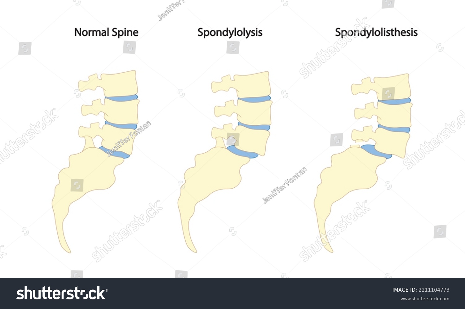 Spondylolysis Spondylolisthesis Illustration Spine Sacral Lateral Stock ...