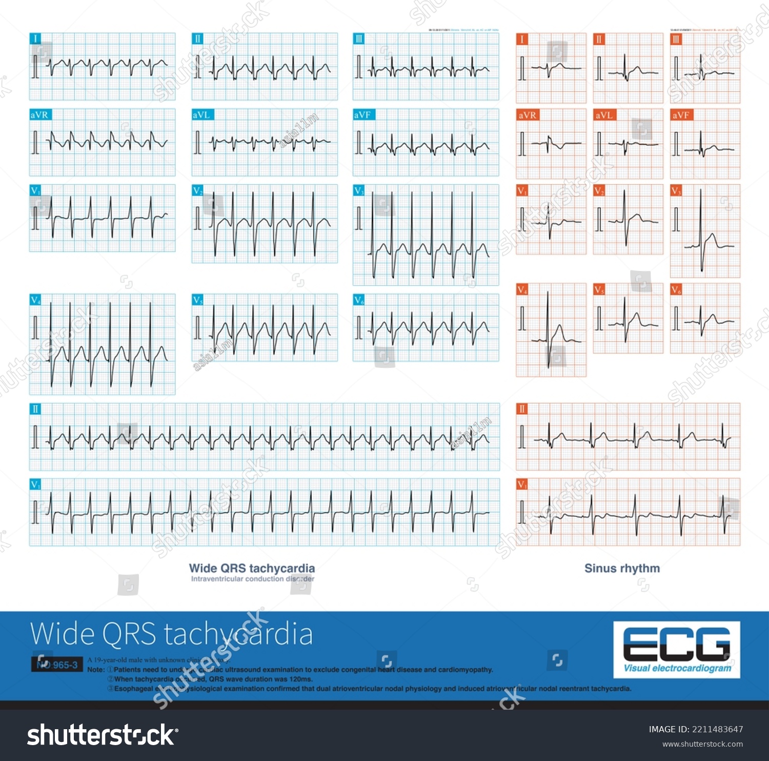 There Basic Intraventricular Conduction Disorder Sinus Stock ...