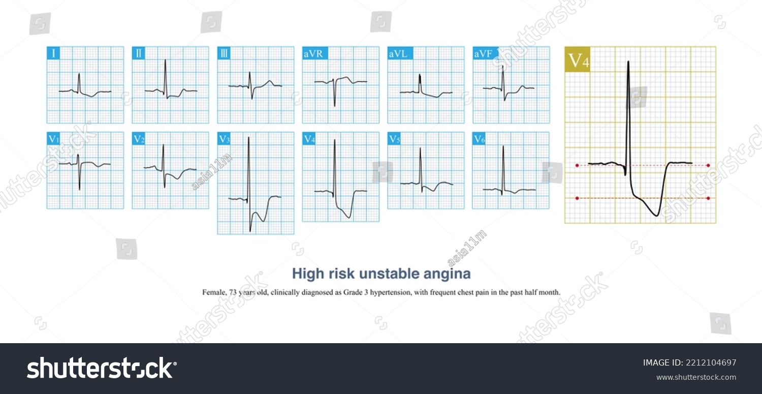 When Clockwise Rotation Basic Ecg Corresponding Stock Illustration ...