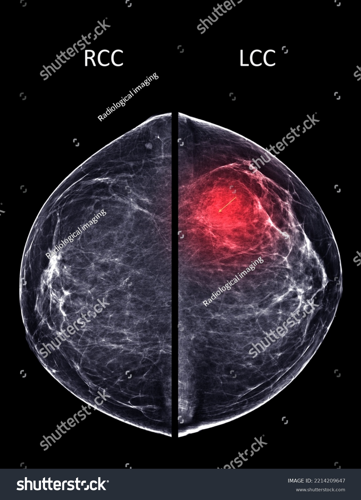 Xray Digital Mammogram Mammography Both Side Stock Illustration Shutterstock