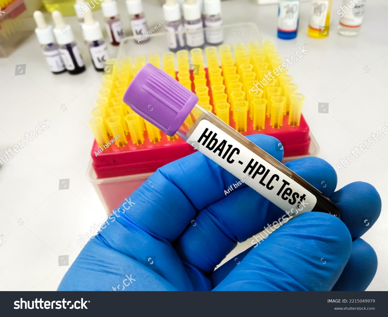 Blood Sample Hba1c Hplc Test Diabetes Stock Photo 2215049979 | Shutterstock