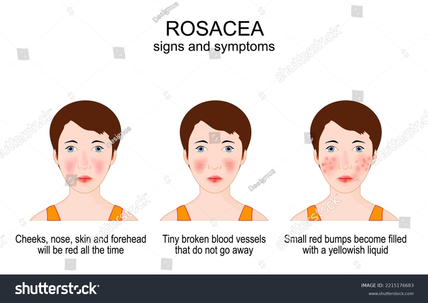 Rosacea Signs Symptoms Acne Rosacea On Stock Vector (Royalty Free ...