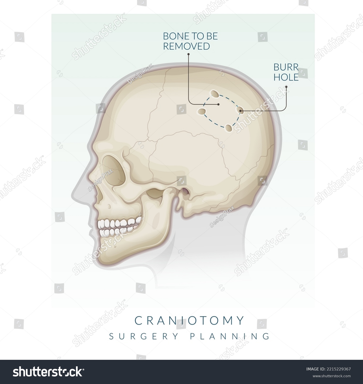 Craniotomy Surgery Bone Flap Removal Stock Stock Vector (Royalty Free ...