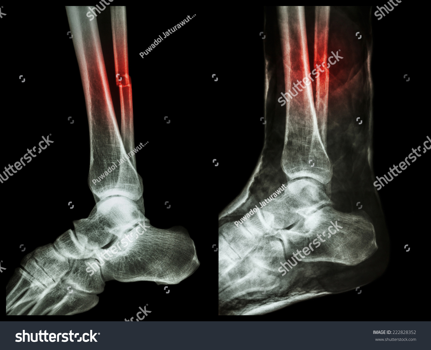 Left Image Fracture Shaft Fibula Calf Stock Photo 222828352 | Shutterstock