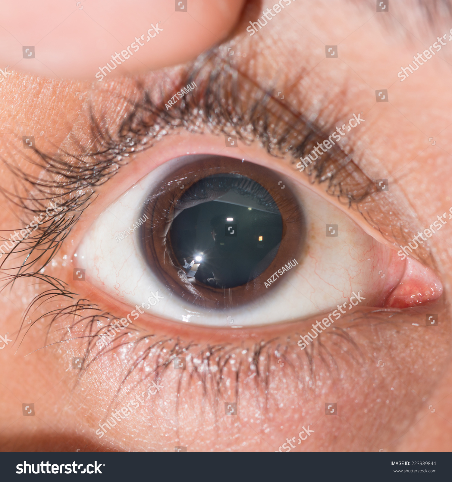 Close Dilated Pupil During Eye Examination Stock Photo 223989844