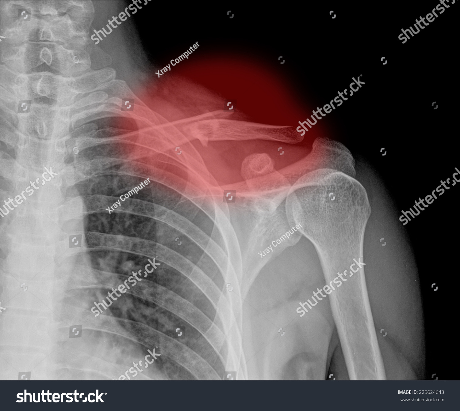 X Ray Collarbone Stock Photo 225624643 Shutterstock