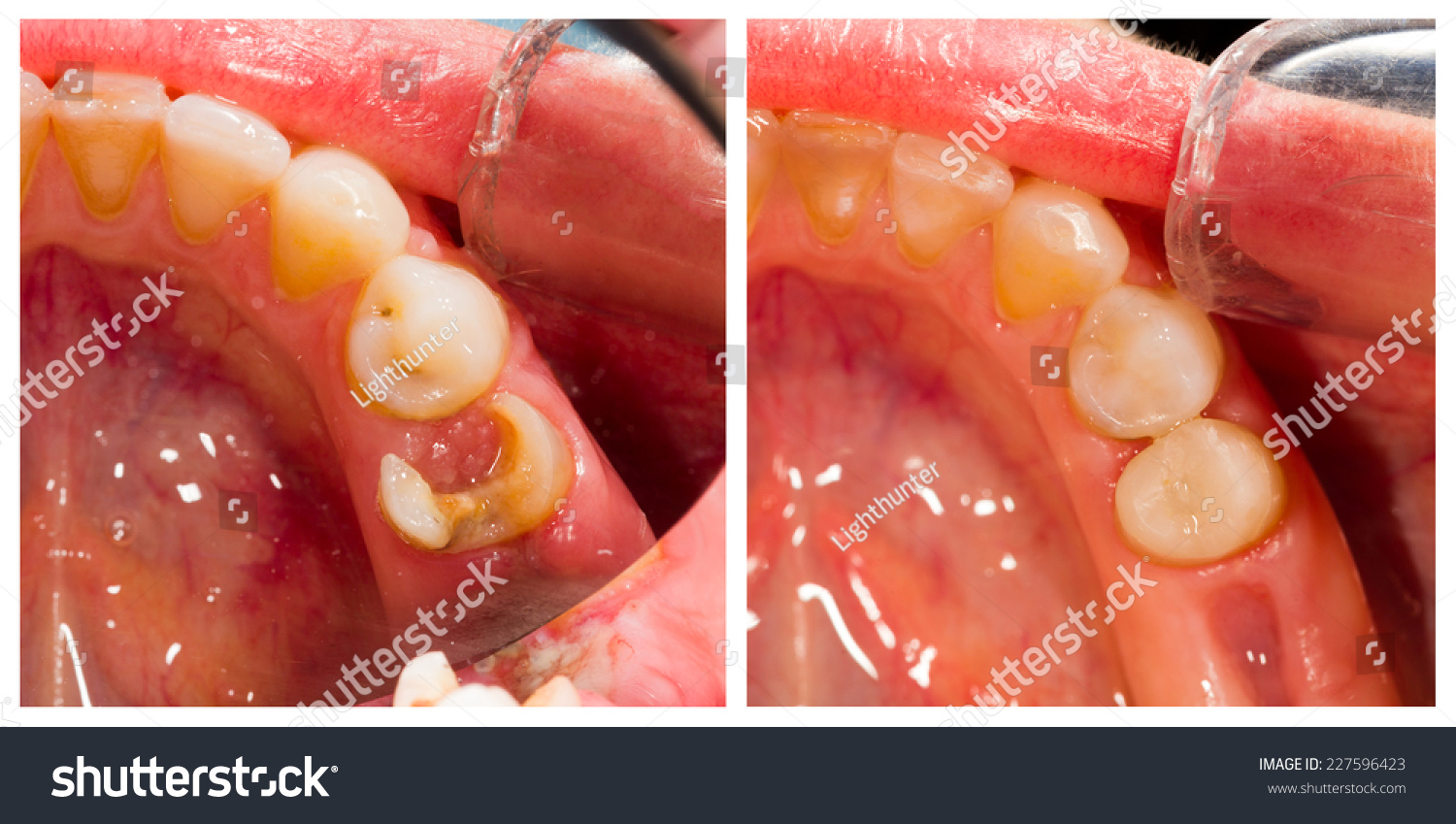 before-after-dental-treatment-beforeafter-series-stock-photo-227596423-shutterstock