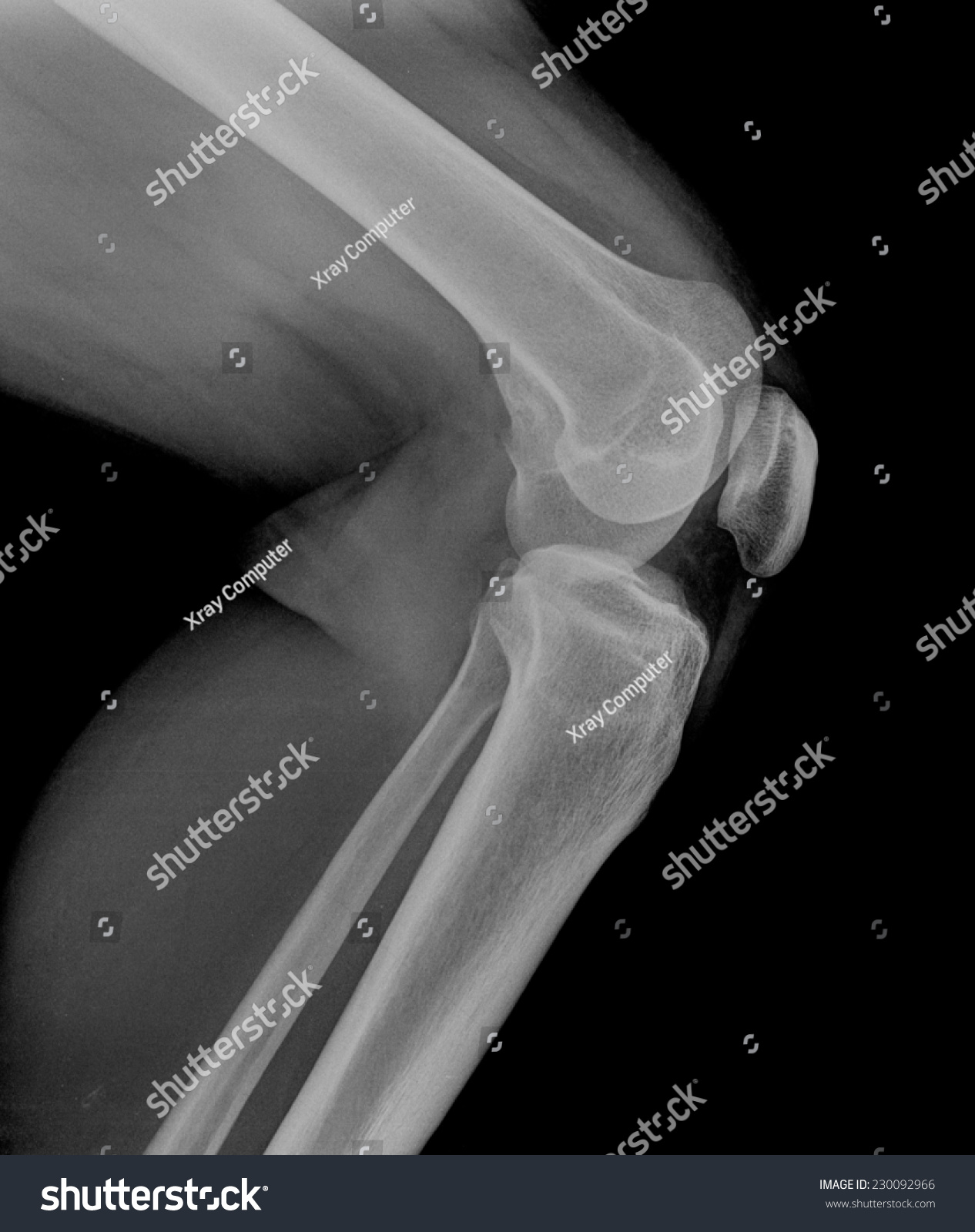 Left Knee Joint Xray Photos Lateral Stock Photo 230092966 | Shutterstock