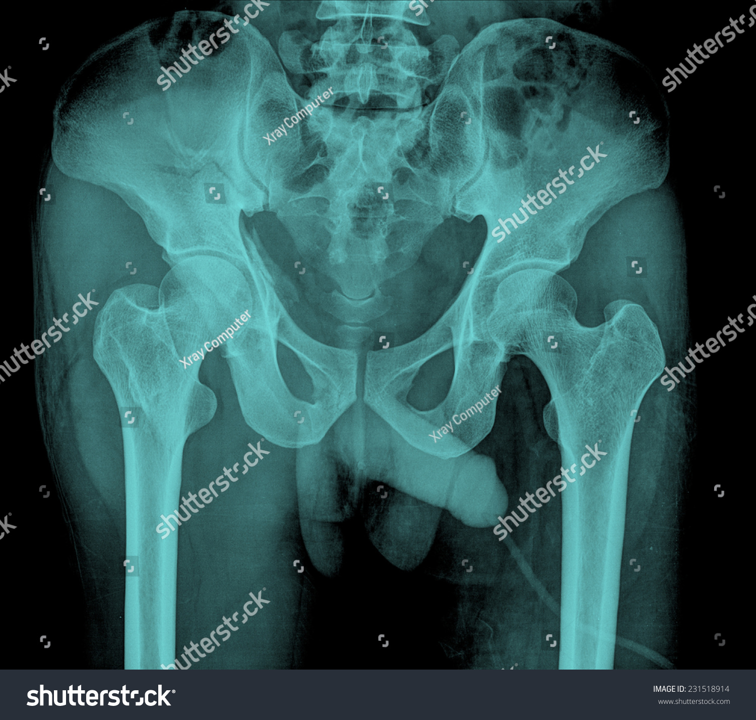 normal hip xray male