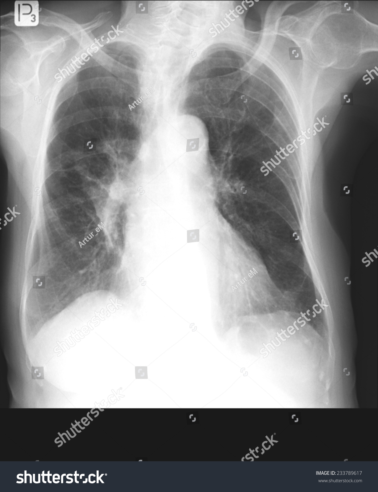 Chest Xrays Durring Lungs Tuberculosis Called Stock Photo 233789617 ...