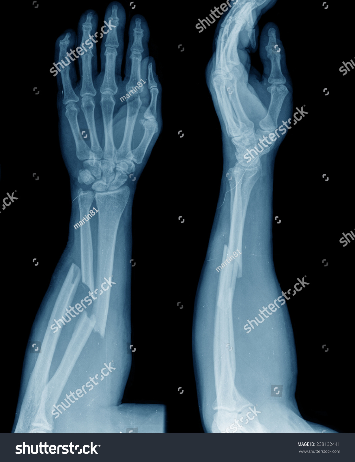 Xray Broken Arms Stock Photo 238132441 | Shutterstock