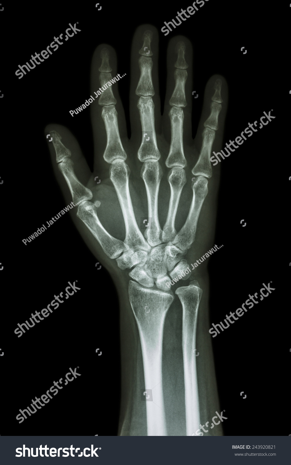 Xray Hand Forearm Ap Anteriorposterior Front Stock Photo 243920821 ...