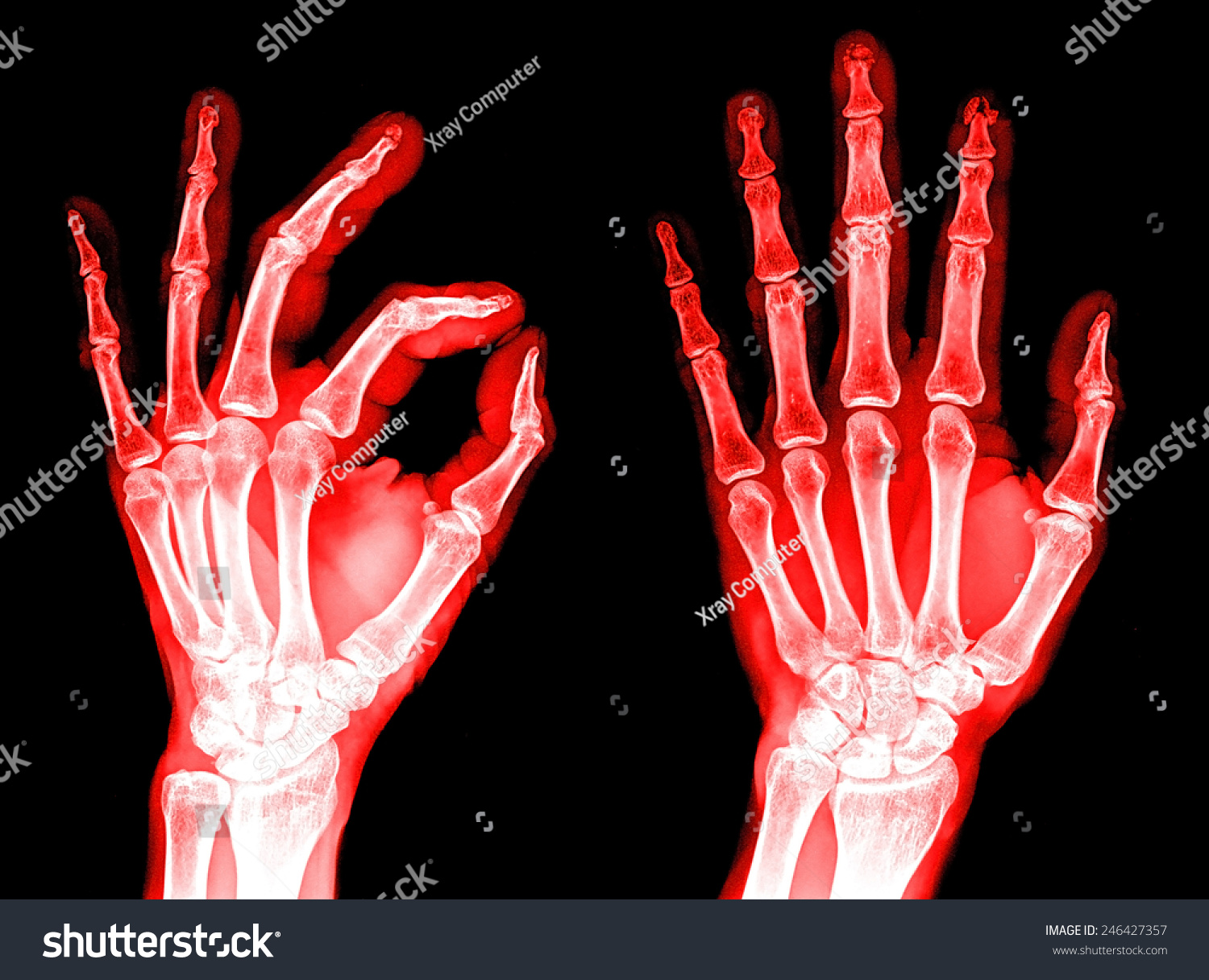 Hand Xray Image Medical Background Stock Photo 246427357 