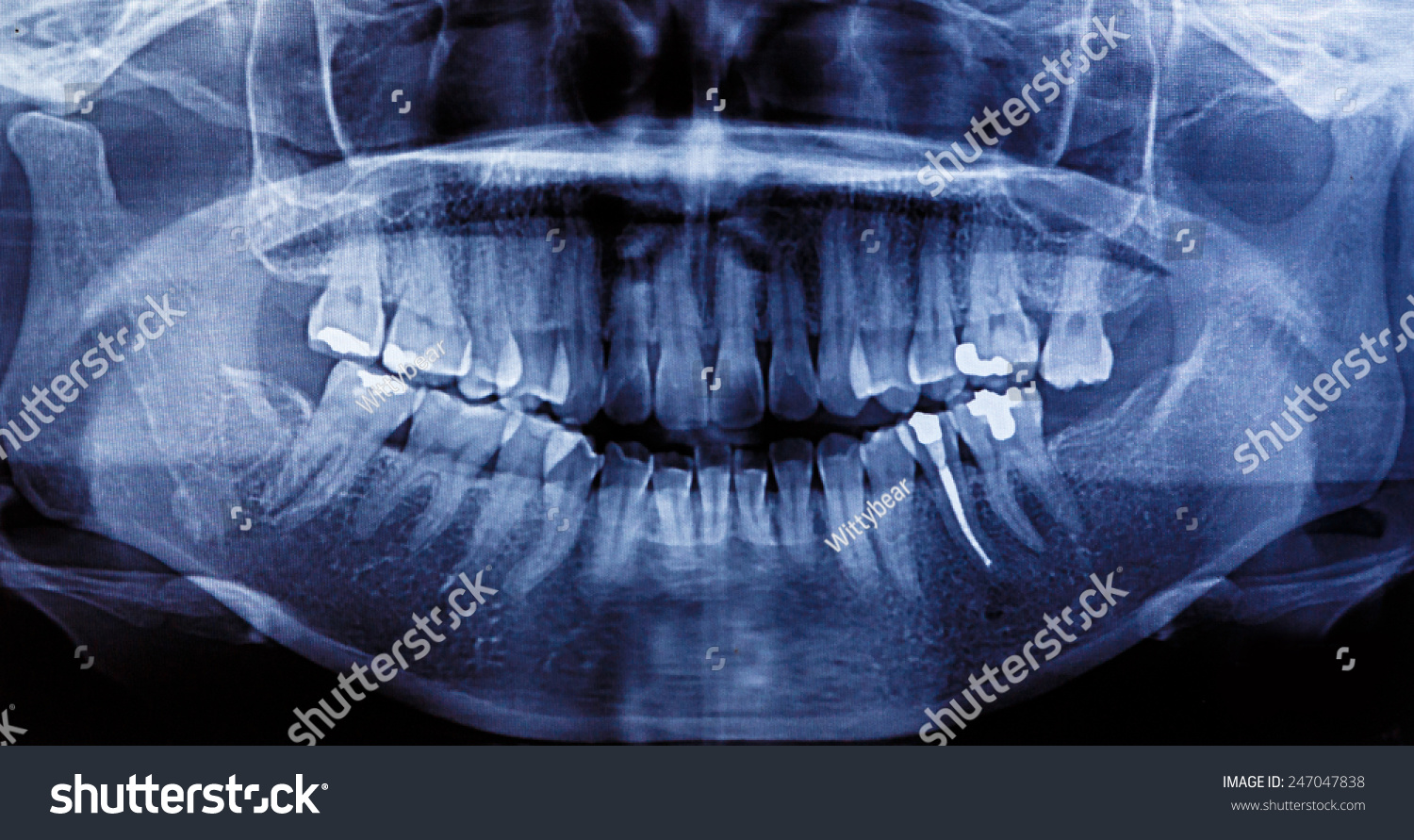 Xray Scan Human Teeth Stock Photo 247047838 | Shutterstock