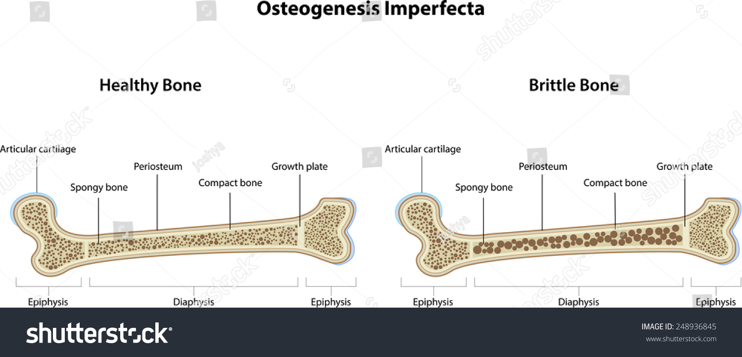 Osteogenesis Imperfecta Stock Illustration 248936845 | Shutterstock