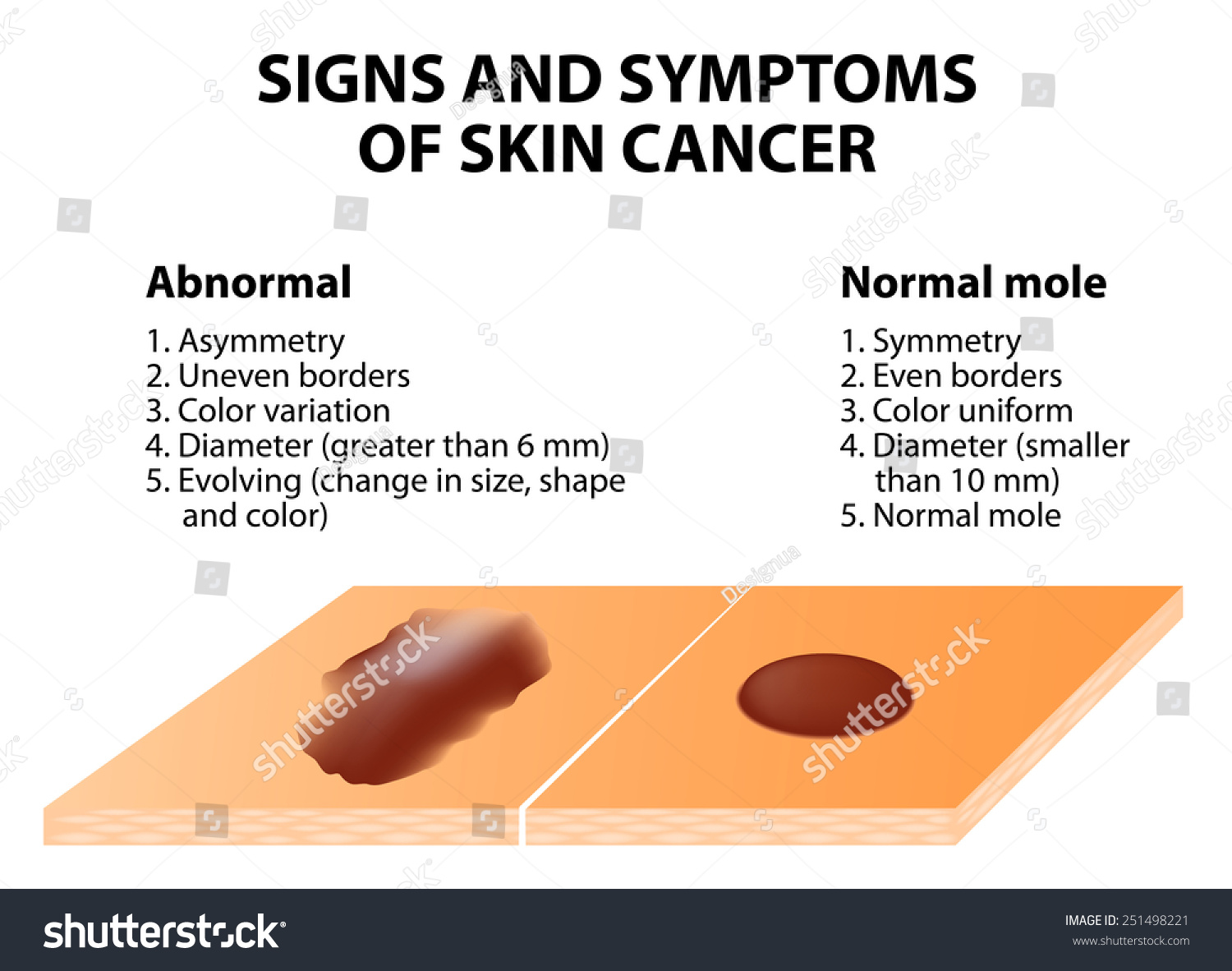 Signs Symptoms Skin Cancer Abcde Guideline Stock Illustration 251498221 ...