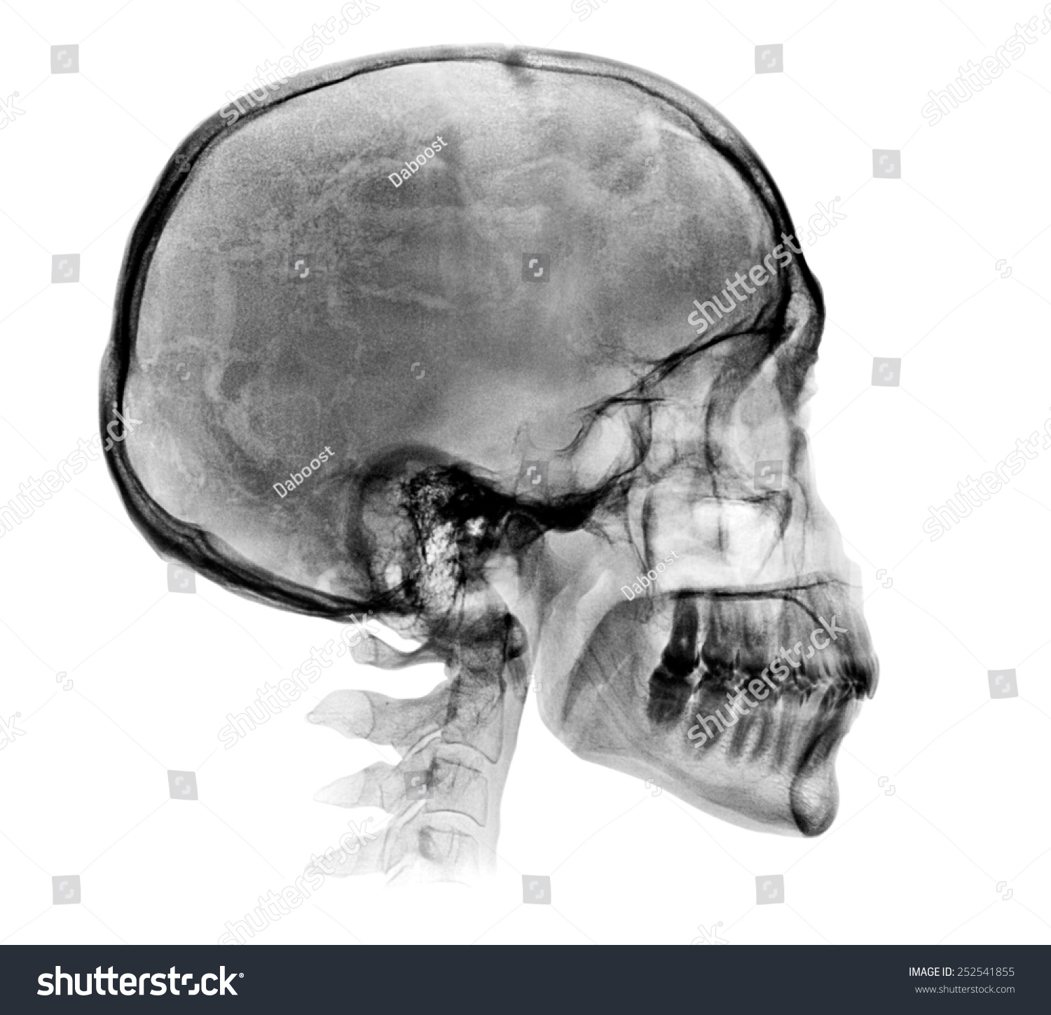 Human Skull Xray Image Isolated On Stock Photo 252541855 | Shutterstock