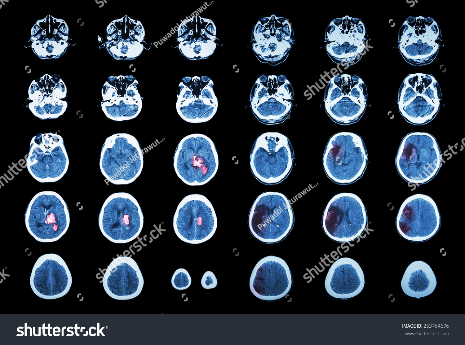 Hemorrhagic Stroke Ischemic Stroke Ct Scan Stock Photo 253764676 ...