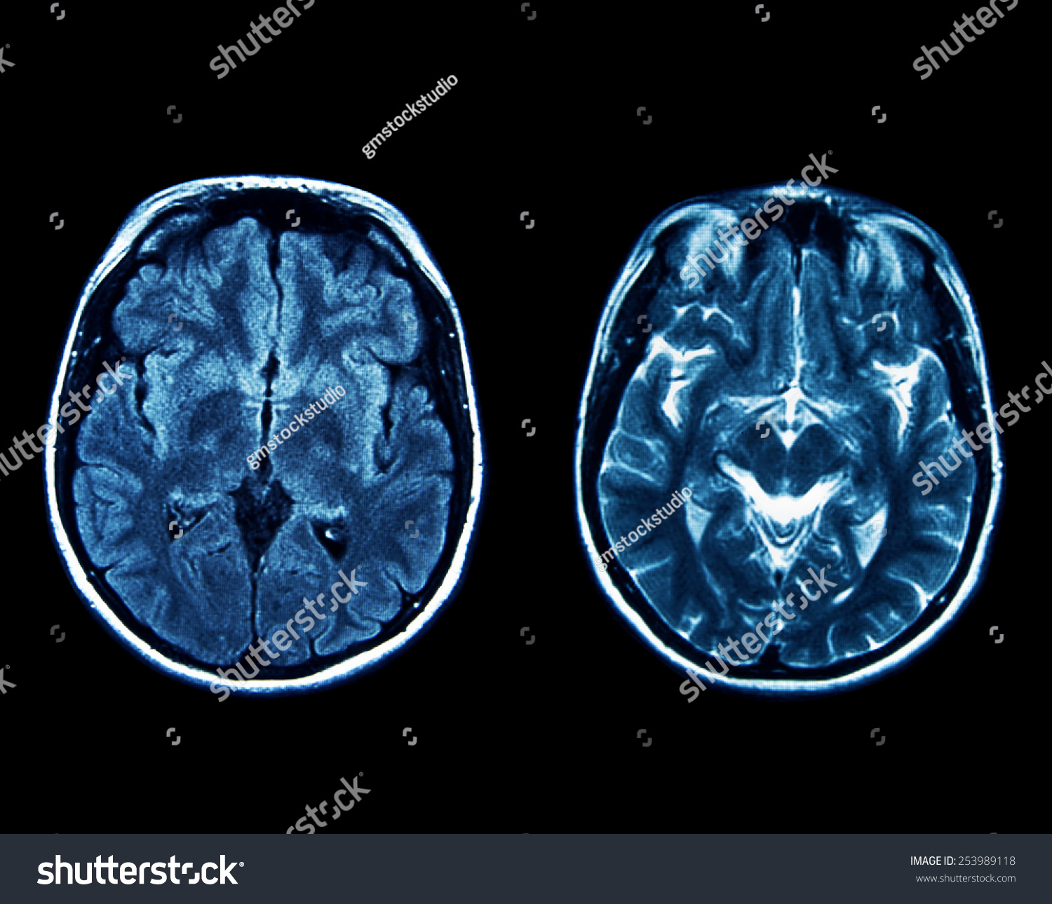 Mri Scan Brain Stock Photo 253989118 | Shutterstock