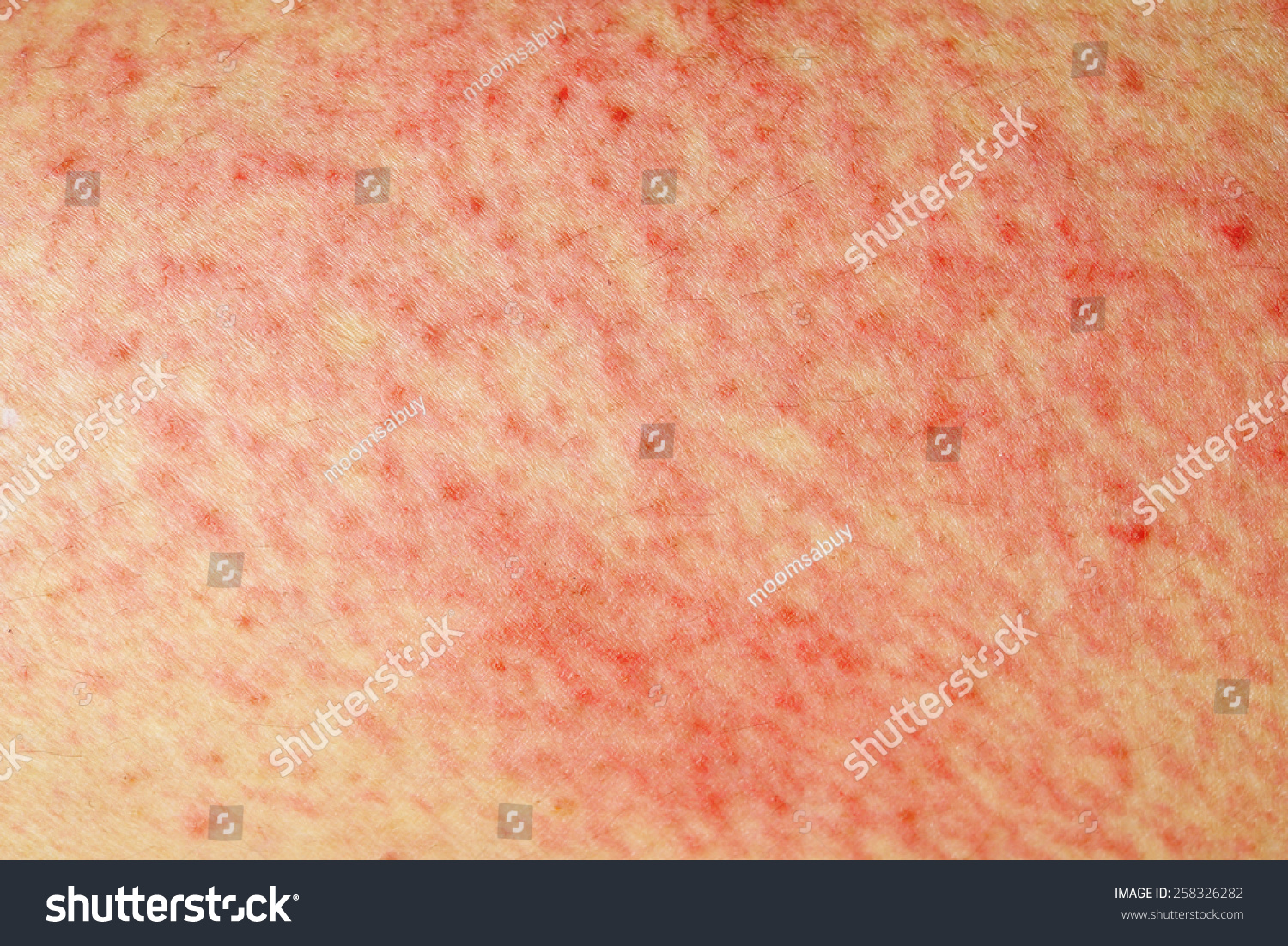 Raised Red Bumps Blisters Caused By Stock Photo 258326282 Shutterstock