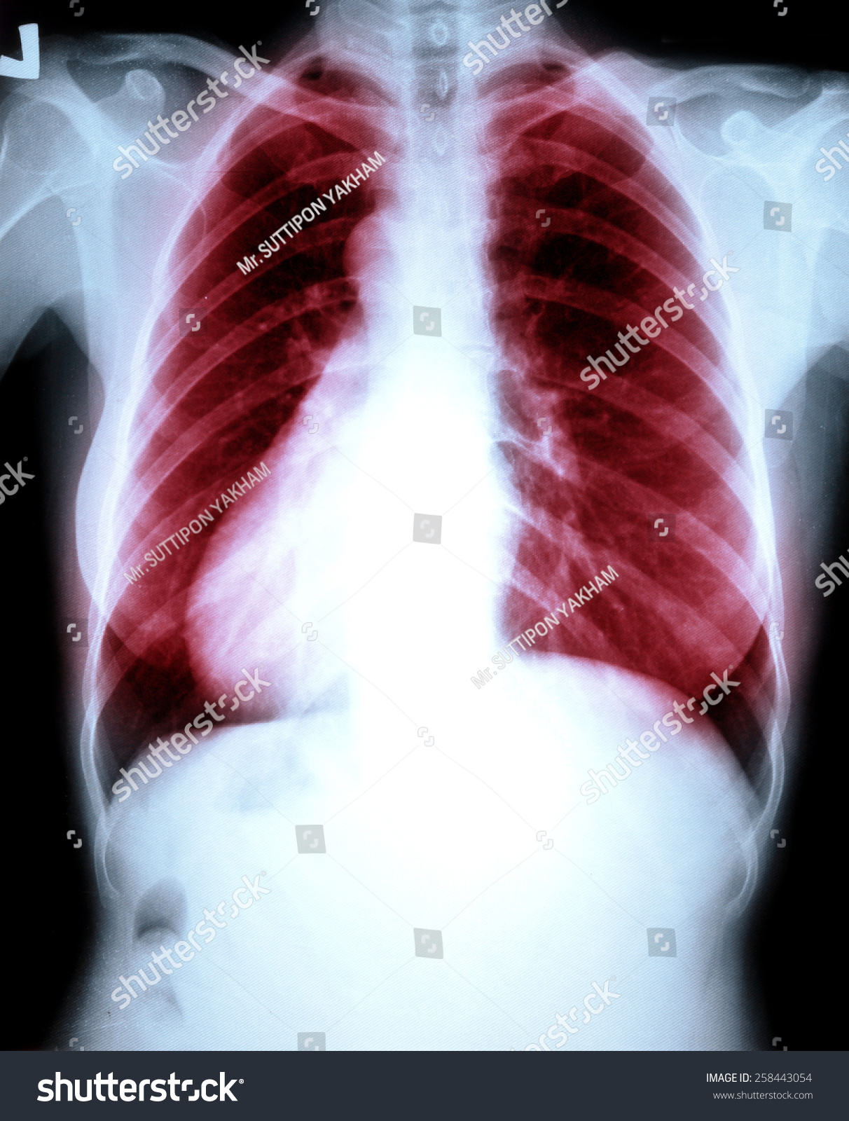 Chest Xray Lung Disease Stock Photo 258443054 | Shutterstock