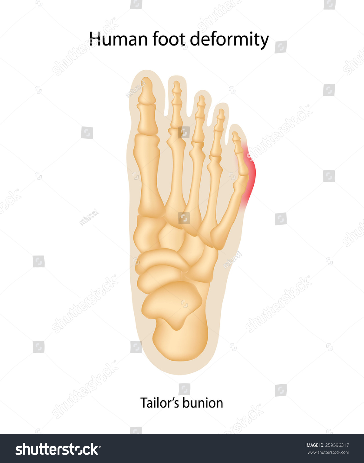 Human Foot Deformity Tailors Bunion Stock Illustration 259596317 ...