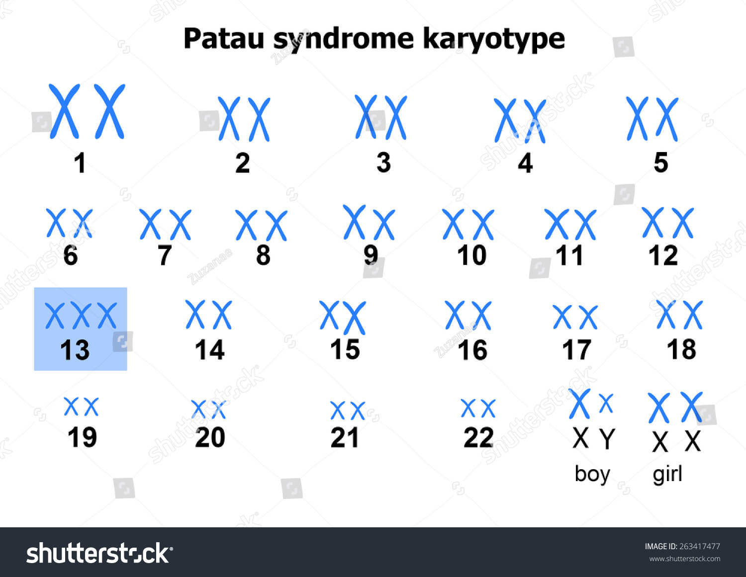 Мальчик с синдромом Патау кариотип