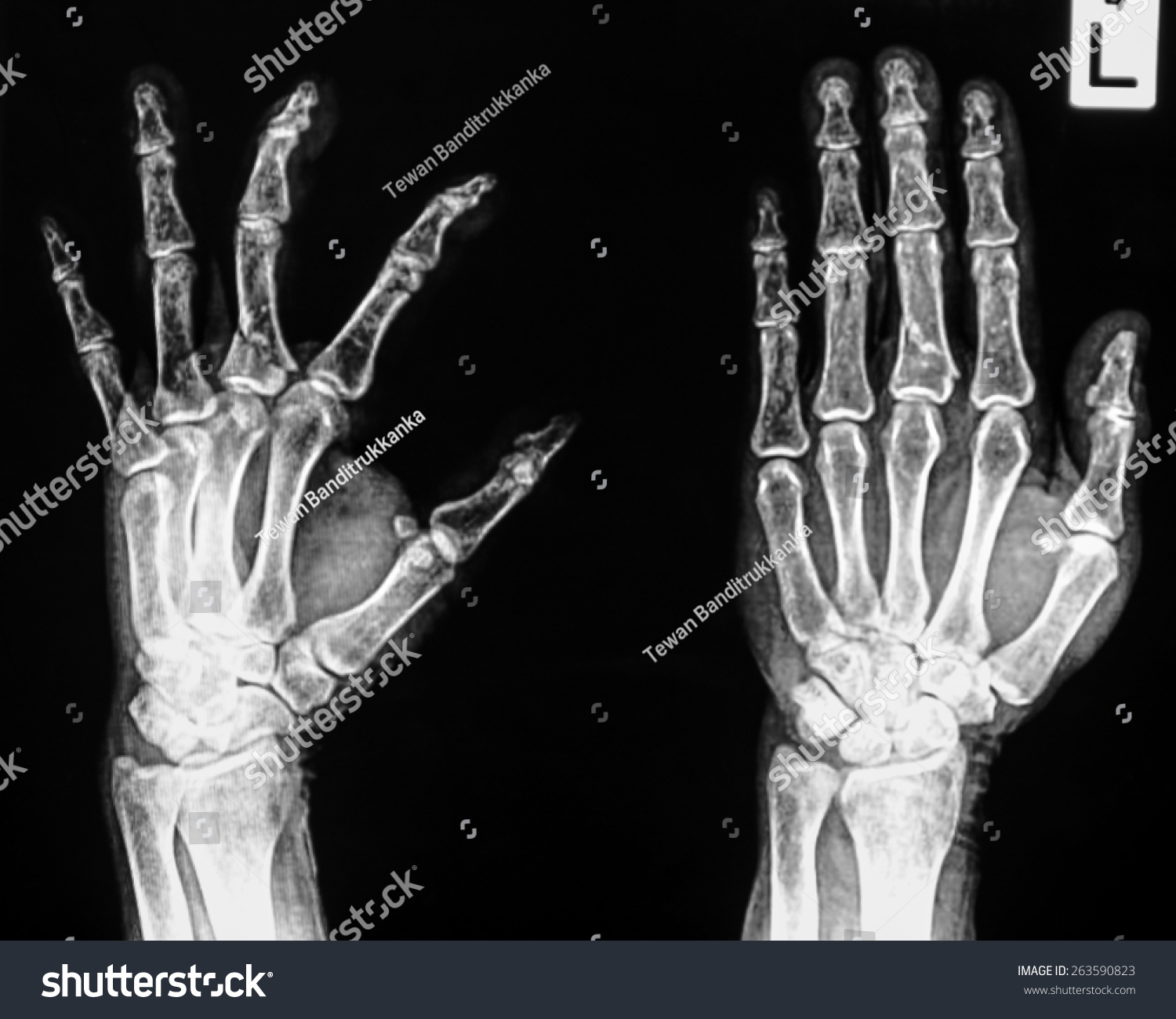 Xray Hand Fractures Stock Photo 263590823 | Shutterstock