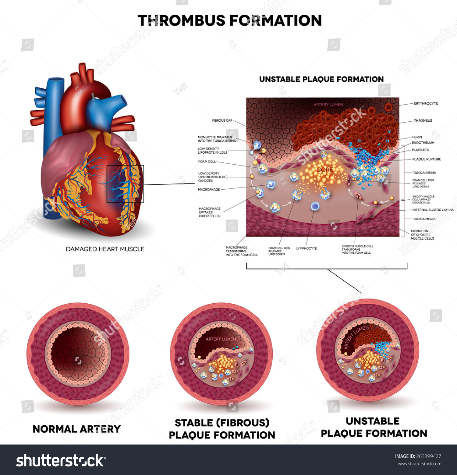 blood-clot-formation-coronary-artery-disease-stock-illustration