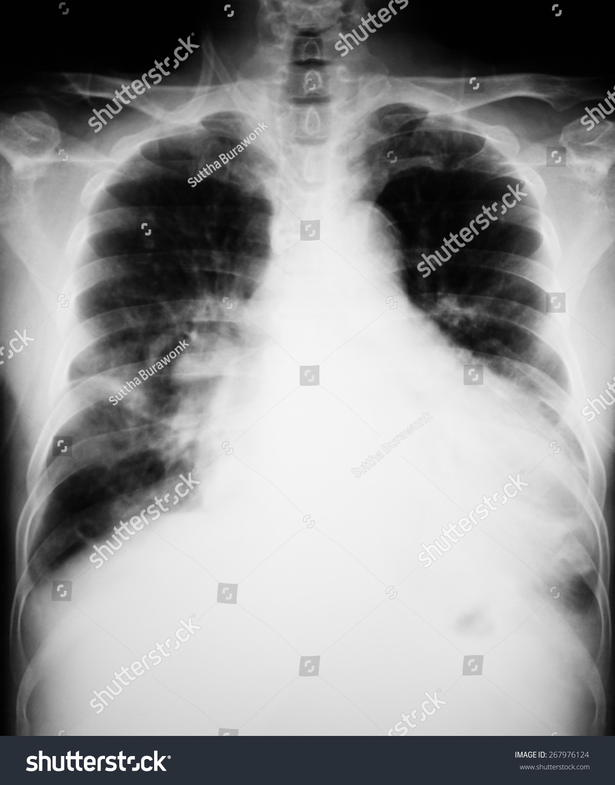 Chest Xray Image Ap Upright View Stock Photo 267976124 | Shutterstock