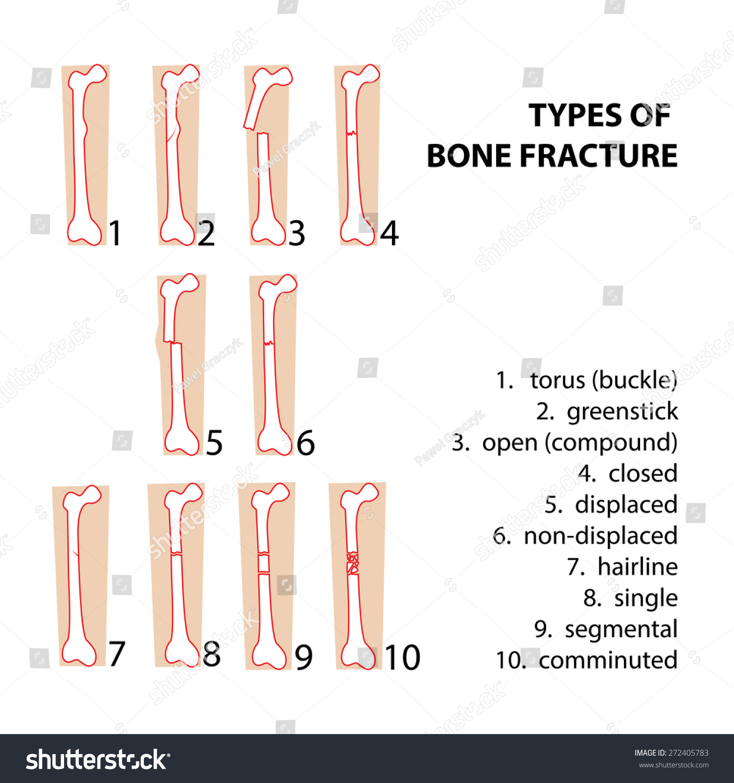 Types Bones Fractures Vector Format Illustration Stock Vector Royalty Free 272405783 4164