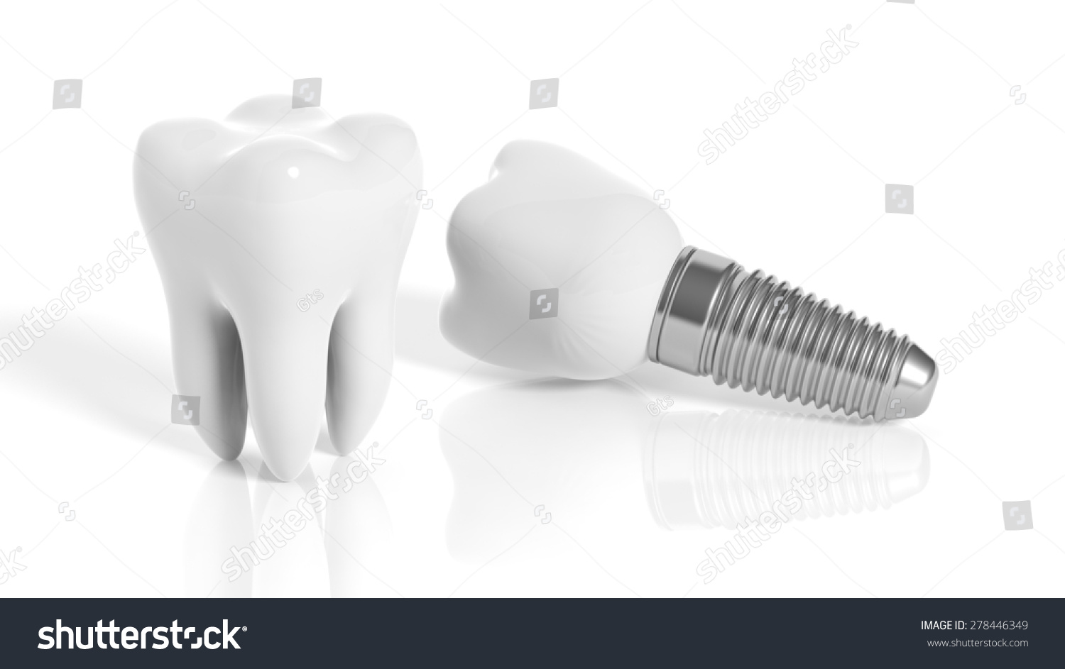 Tooth Dental Implant Isolated On White Stock Illustration 278446349 ...