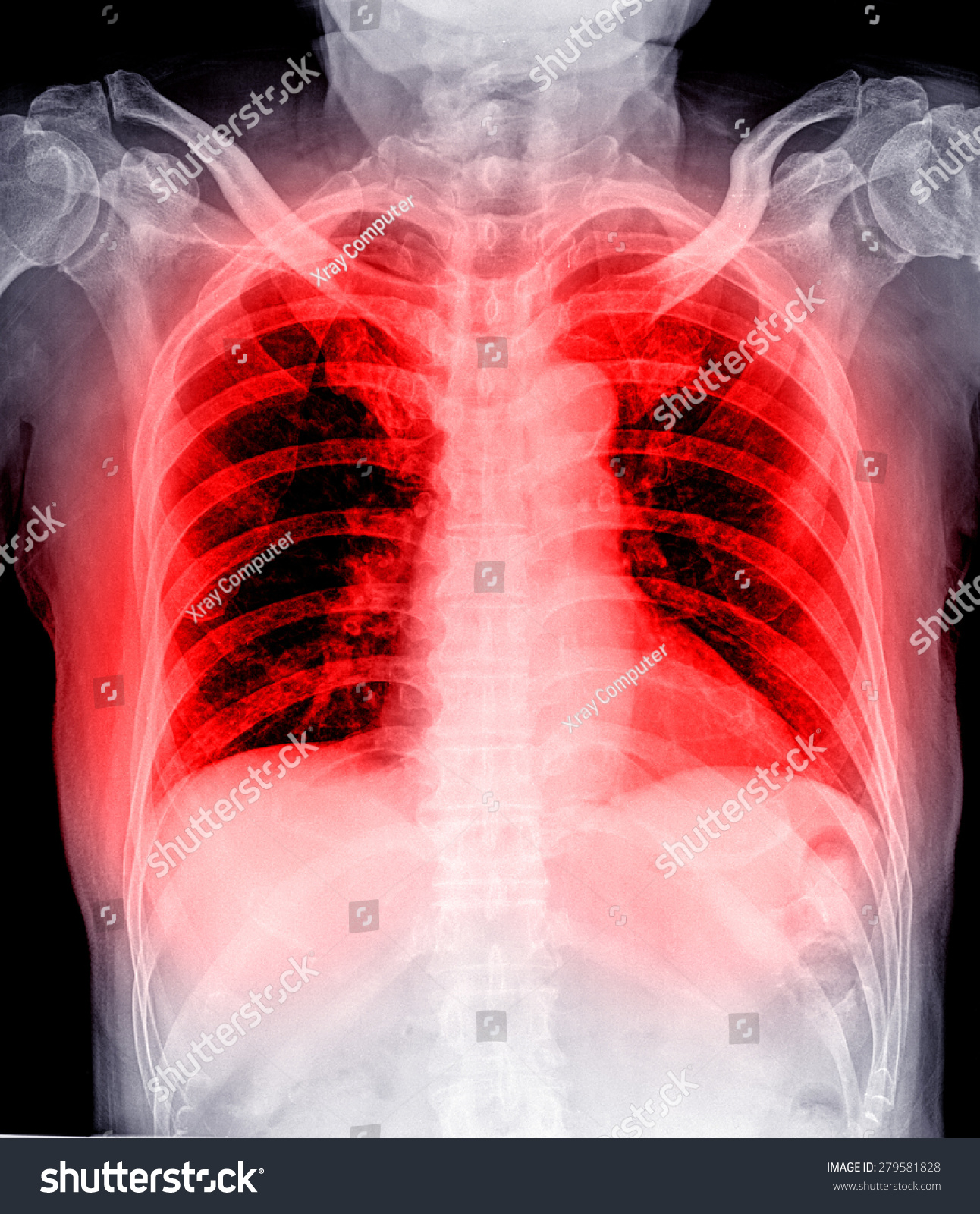 Xray Image Human Chest Medical Diagnosis Stock Photo 279581828 ...